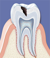 Les caries dentaires