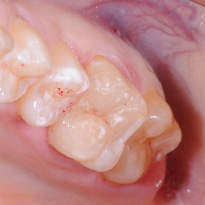 Les inlays et les onlays sont des reconstitutions de dents fabriquées par le prothésiste (technicien dentaire). Cette méthode de soins indirecte passe par des empreintes.